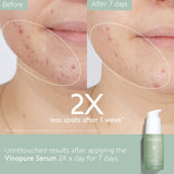 Caudalie The Anti Blemish Duo
